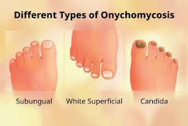 Image result for onychomycosis