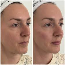 Refreshed but still you! Aesthetics is at its best when facial harmony is  enhanced. No one can place what you’ve had done but they know you look  refreshed and well rested. , This beautiful bride to be ...