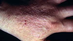 We'll explain how herpes simplex is transmitted, symptoms, and treatment options. Is It Herpes Or Something Else Everyday Health