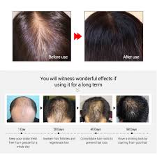 It does have a good price, but its effect isn't amazing: Hair Oil For Hair Loss Hair Gain Oil Wild Hair Growth Best Hair Oil For Hair Loss Wild Growth Hair Care Fast Hair Growth Oil Best Oil For Fast Hair Growth