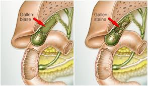 Single Port Technik In Der Gallenblasenchirurgie Leading Medicine Guide