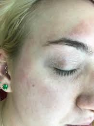 It's a cheap and effective natural treatment for itchy skin, and so much more. Skin Concerns My Face Is Itchy And Peeling I Have Eczema But Nothing Is Helping Advice Skincareaddiction