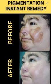 I have pigmentation since a long time and nothing works....so tensed about  it now ...plz suggest how can I reduce it...