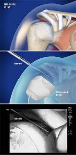 Image result for Shoulder Injection