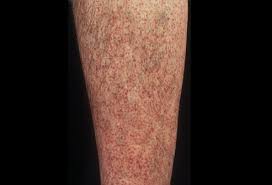 Rashes may cause the skin to change color, itch, become warm, bumpy, chapped, dry, cracked or blistered, swell, and may be painful. Graves Disease Picture Image On Medicinenet Com