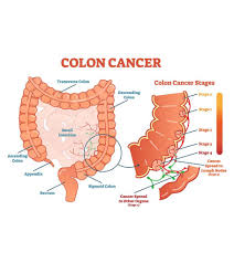 Complete information about rectal cancer, including signs and symptoms; 6 Symptoms And 11 Risk Factors Of Colon Cancer In Teens