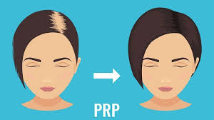 What Is Platelet Rich Plasma Therapy Prp For Hair Loss Everyday Health