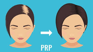 Prp stands for platelet rich plasma. What Is Platelet Rich Plasma Therapy Prp For Hair Loss Everyday Health