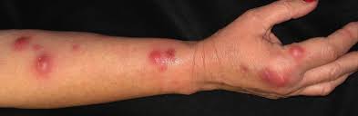 Image result for Nodular Lymphangitis
