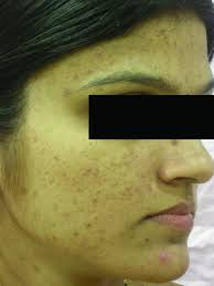 Post Acne Scars And Pigmentation Before Glycolic Acid Peel Download Scientific Diagram