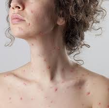 جدرى الماء قد يصيب الكبار أيضا وهذه أبرز أعراضه اليوم السابع