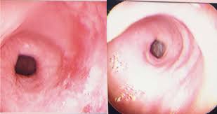 Image result for Porfimer