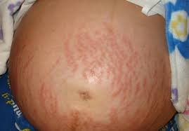 Image result for pruritic urticarial papules and plaques of pregnancy