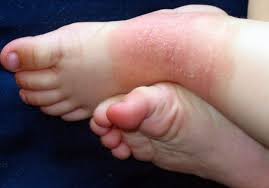 These areas often include the face, arms, backs of the hands, v shaped area of the upper chest and lower neck. The Best Sun Creams For Babies And Children With Eczema Manchester Evening News