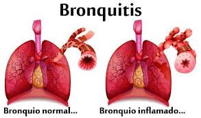 La bronquitis crónica es la inflamación e irritación de los conductos bronquiales, las vías respiratorias que llevan oxígeno a los alvéolos en sus pulmones. Q Facultad Ciencia De La Salud Informacion No Oficical Facebook