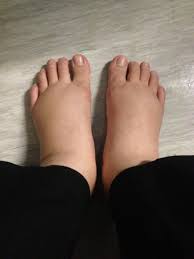 Jika kaki mulai bengkak sejak awal kehamilan, bunda wajib waspada. Kaki Bengkak Saat Hamil Berikut Ini Tips Untuk Mengatasinya