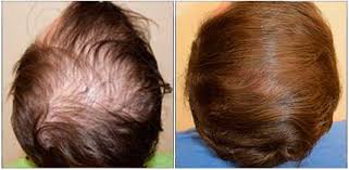 Steroid injections work for hair loss that occurs when the body's own immune system starts fighting hair follicles. Prp Philadelphia Pa The Griffin Hair Restoration Center