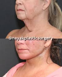 Neck // deleted. 70 years old, 24 hours after #neckbynayak( and more) She  may decide to show full face as she heals 🤞
