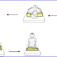 The canalith repositioning procedure can help relieve benign paroxysmal positional vertigo (bppv), a condition in which you have brief, but intense, episodes of dizziness that occur when you move your head. Modified Epley Maneuver For Treating Right Sided Bppv Download Scientific Diagram