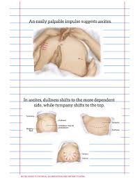 Image result for Shifting Dullness Test