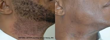 Laser hair removal can be used for the treatment of the face below the cheek line, for example, the upper lip and chin. Are There Any Permanent Facial Hair Removal Procedures For Men That Isn T Laser Hair Removal I M Sick Of Having To Shave Everyday It Grows Too Fast Is This Possible Quora