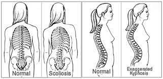 Scoliosis Is An Abnormal Curvature Of The Spine In Scoliosis The Spine Curves To The Side When Viewed From Scoliosis Treatment Scoliosis Health Care Services