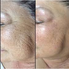 What An Amazing Transformation After A Vi Peel Notice The Difference In Texture And Radiance Of Her Skin Chemical Peel Medical Aesthetic All Things Beauty
