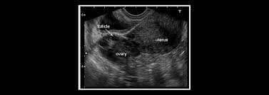 Check spelling or type a new query. Sonography Test During Pregnancy Ultrasonography And Pelvic Ultrasound Suburban Diagnostics