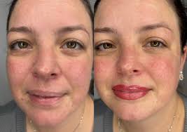 A good lip blush treatment can really bring some gorgeous warmth and  symmetry to your face. The pigment will heal lighter and give that subtle  'blush' look along with giving your lips