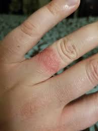 If your allergic reaction to gold is a severe one, you could also although it may appear that you are allergic to gold, you will probably find that you can wear rings. Looks Like I Have An Allergy To My Silver Ring What Is A Good Alternative That Would Have The Same Similar Look Jewelers