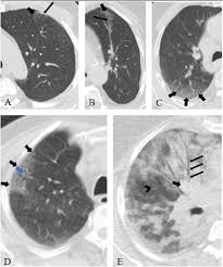 A ct gives a way for. A Review On Chest Ct Scanning Parameters Implemented In Covid 19 Patients Bringing Low Dose Ct Protocols Into Play Egyptian Journal Of Radiology And Nuclear Medicine Full Text