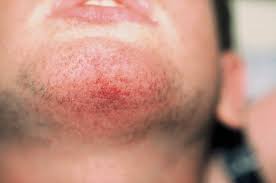 You will find them all over your skin in various parts of your body but mostly in your arms and lower legs. Figure 1 From Papular Purpuric Rash Due To Parvovirus B19 With Distribution On The Distal Extremities And The Face Semantic Scholar