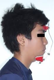 Correction of maxillary hypoplasia with MSE (Maxillary Skeletal Expander)  and facemask supported by mini-implants