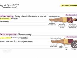 Image result for Decorticate Posturing