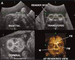 Genetic Sonography 3d Us