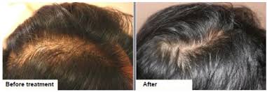 If you are using the rejuviss advanced derma roller system , which comes with 4 different dermaroller heads,the 600 micro needles/0.5mm derma roller is recommended for the first few weeks of use. Dermaroller Hair Regrowth Surrey Skinvisual Medical Spa