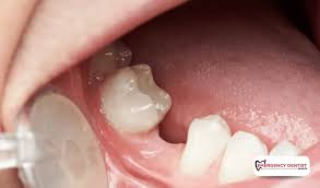 Image result for Dry Socket