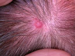 Image result for white scabs on the head in children