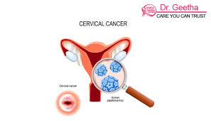 The treatment of cervical cancer is based on the figo 2009 cervical cancer staging. Cervical Cancer Treatment In Hyderabad Dr Geetha Nagasree