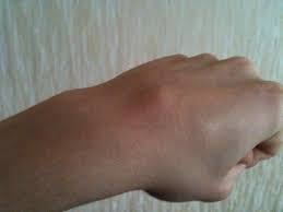 Beule Auf Handrucken Was Ist Das Hand