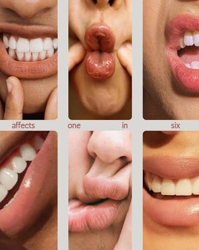 The Tooth Studio | MIH affects 1 in 6 kids and shows up as weak enamel on  the molars and incisors. 🦷 It can be mild, moderate, or pretty severe, and  often... | Instagram