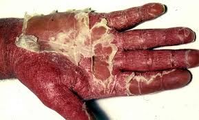 Image result for psoriasis