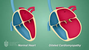 Cardiomyopathy St Vincent S Heart Health