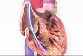 This page is about the various possible meanings of the acronym, abbreviation. Living With Your Implantable Cardioverter Defibrillator Icd American Heart Association