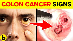 However, there is no specific sign or symptom that definitely indicates colon cancer is present. 11 Early Signs Of Colon Cancer You Need To Know Youtube