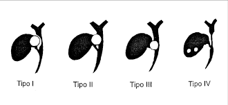 Os dados da classificação da liberdade de imprensa 2021. Classificacao Da Sindrome De Mirizzi Segundo Nagakawa Modificado De Download Scientific Diagram