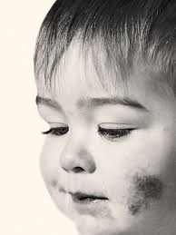 Image result for Atopic eczema atopic dermatitis