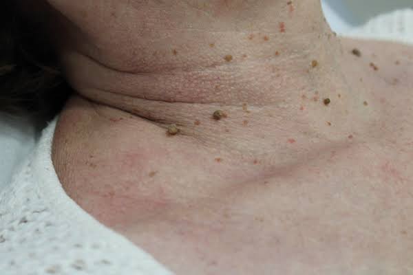 Verrugas | Centro Dermatológico Estético de Alicante | 965 140 460