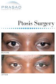 Eyelid Ptosis Surgery In 2020 Eye Lift Surgery Plastic And Reconstructive Surgery Surgery