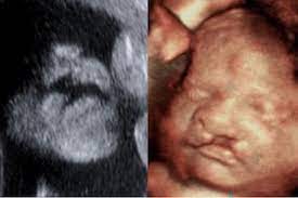 Why To Avoid Keepsake 3 D And 4 D Ultrasounds Your Pregnancy Matters Ut Southwestern Medical Center